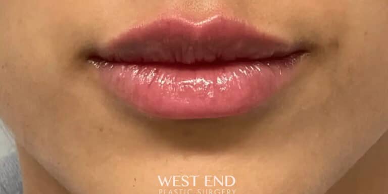 After Image: Lip Filler - front