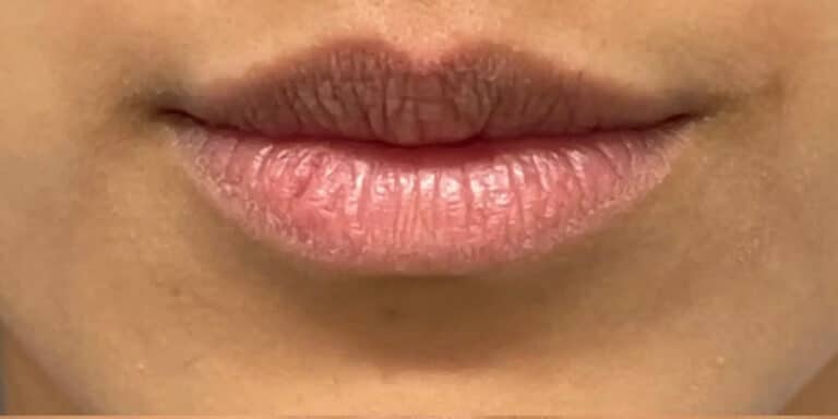 Before Image: Lip Filler - front