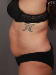 Before Image: CoolSculpting