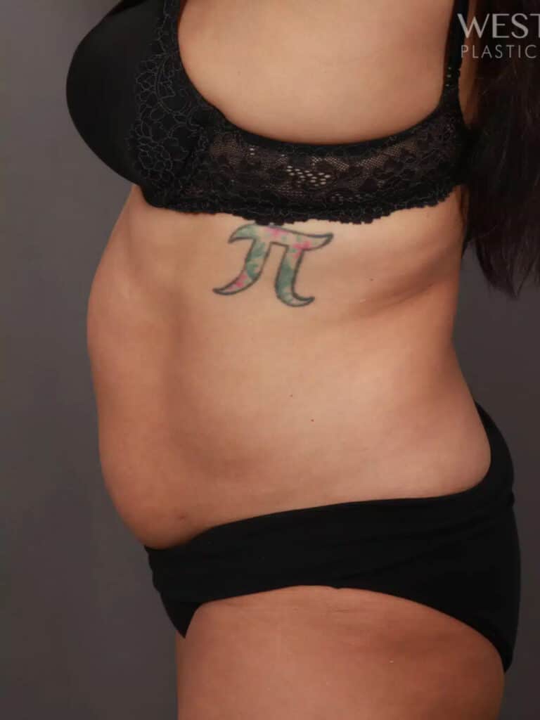 Before Image: CoolSculpting - left-side