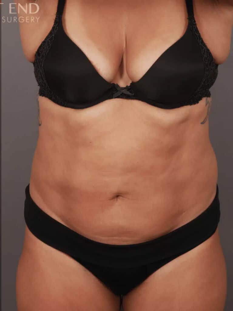 After Image: CoolSculpting - front