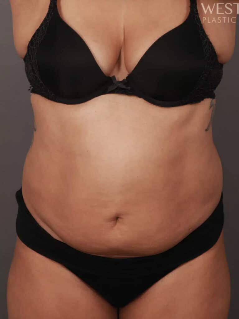 Before Image: CoolSculpting - front
