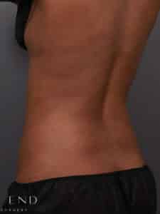 After Image: CoolSculpting
