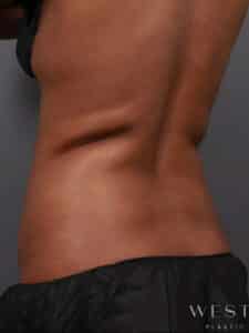 Before Image: CoolSculpting