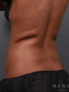 CoolSculpting