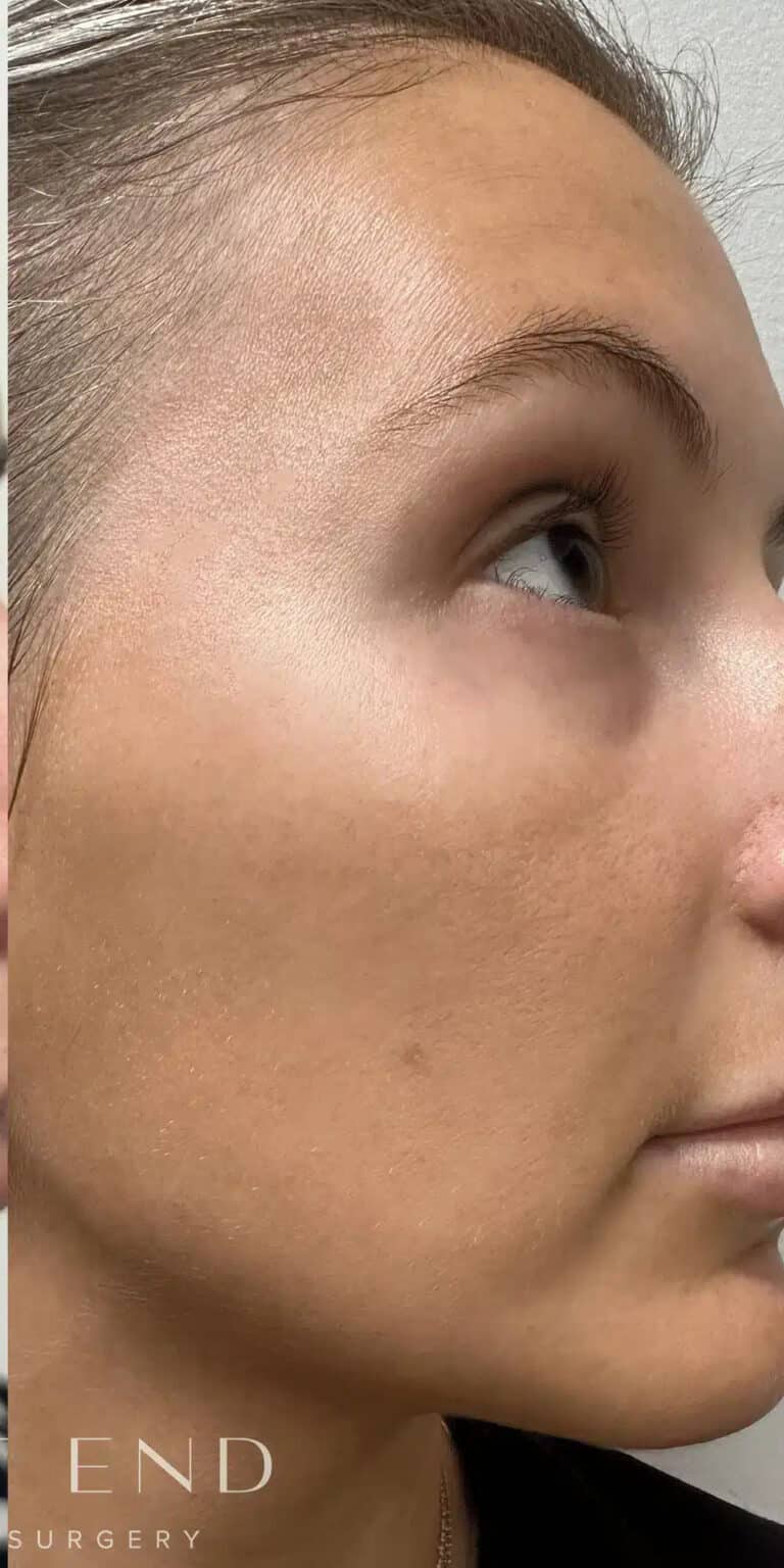 After Image: Laser Genesis - right-side