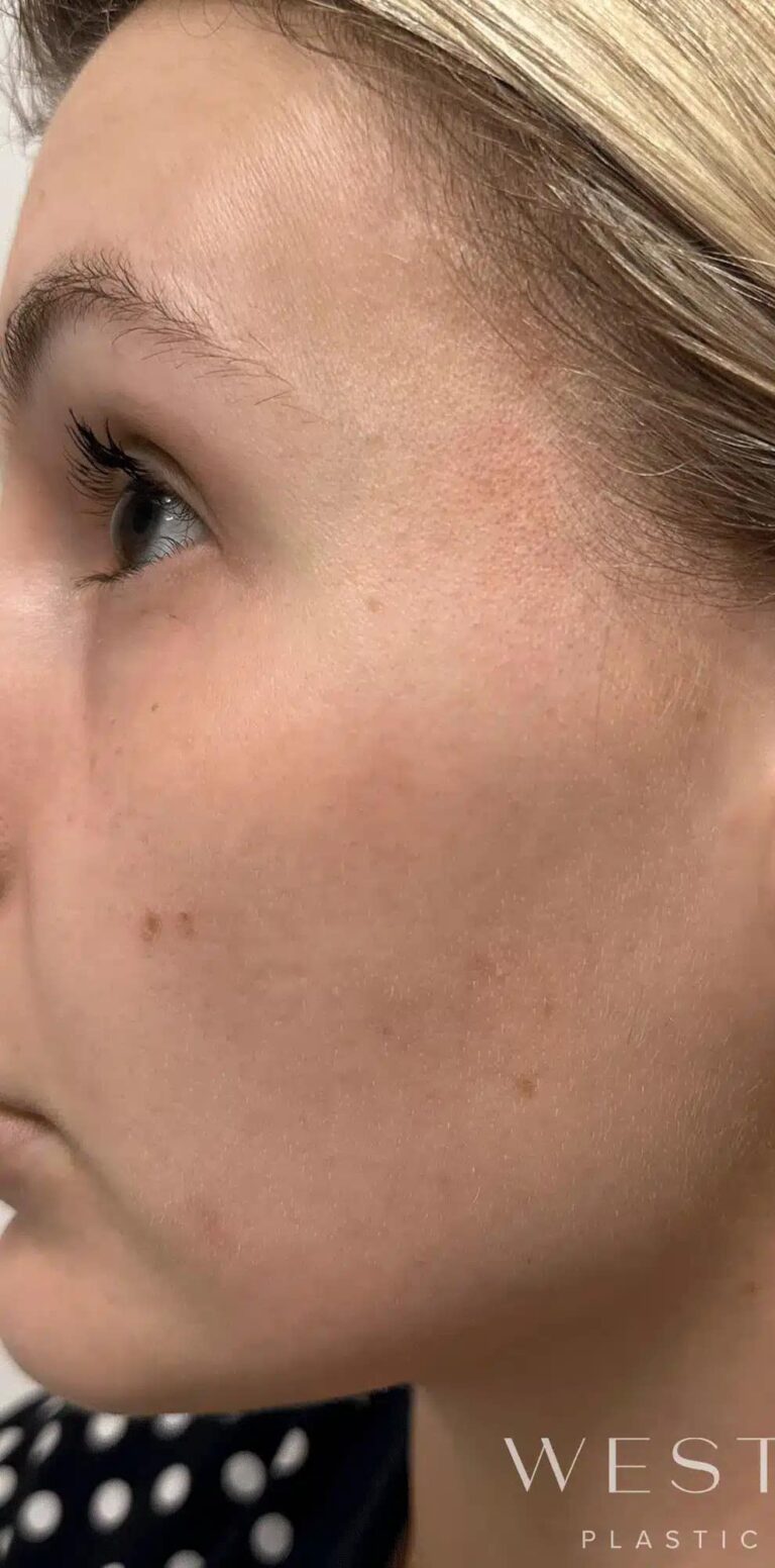 Before Image: Laser Genesis - left-side