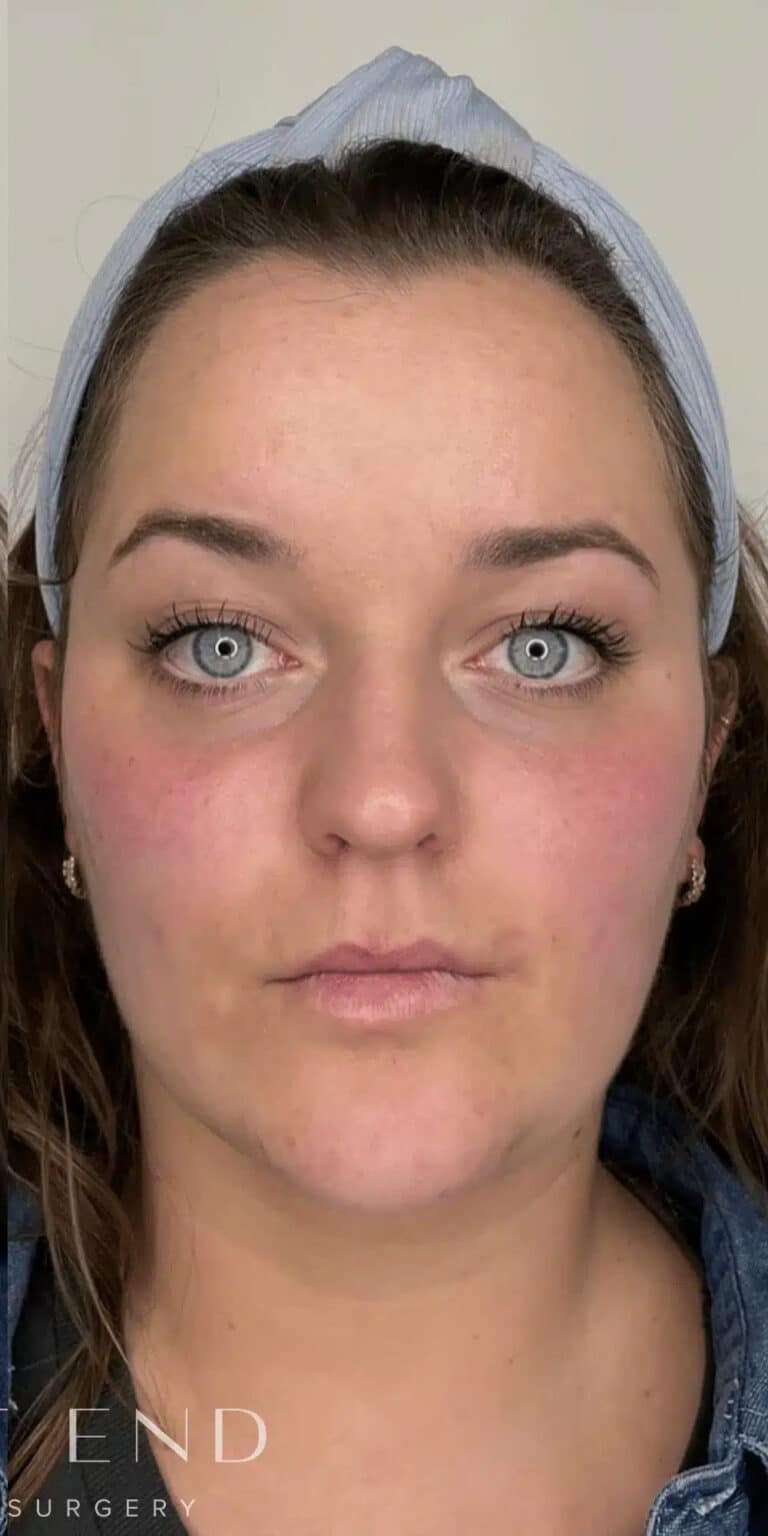 After Image: Cheek, Under-Eye, and Chin Filler - front
