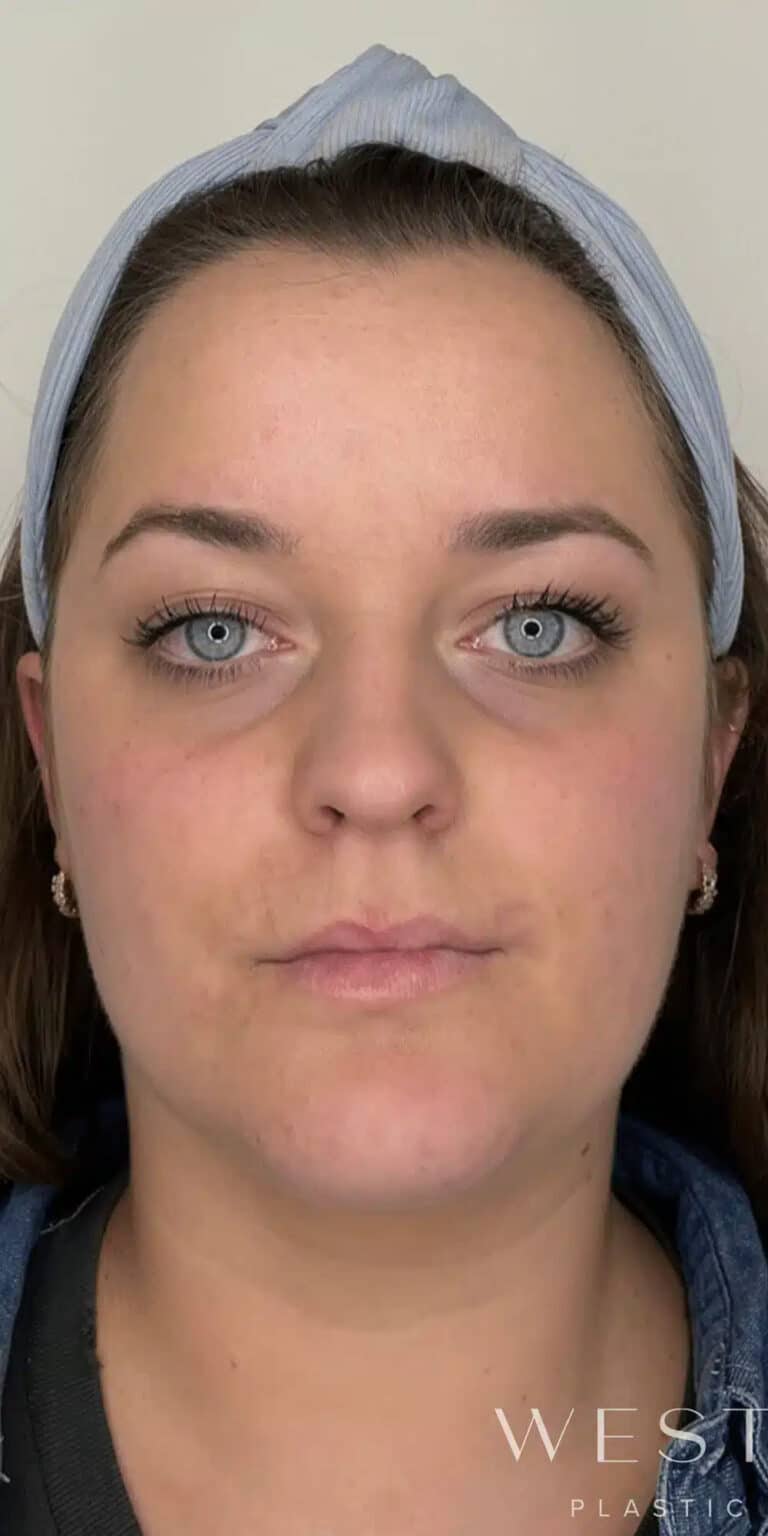 Before Image: Cheek, Under-Eye, and Chin Filler - front
