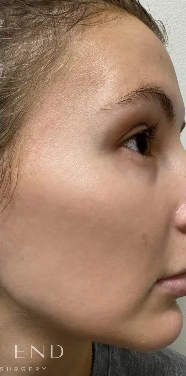 After Image: Laser Genesis - right-side