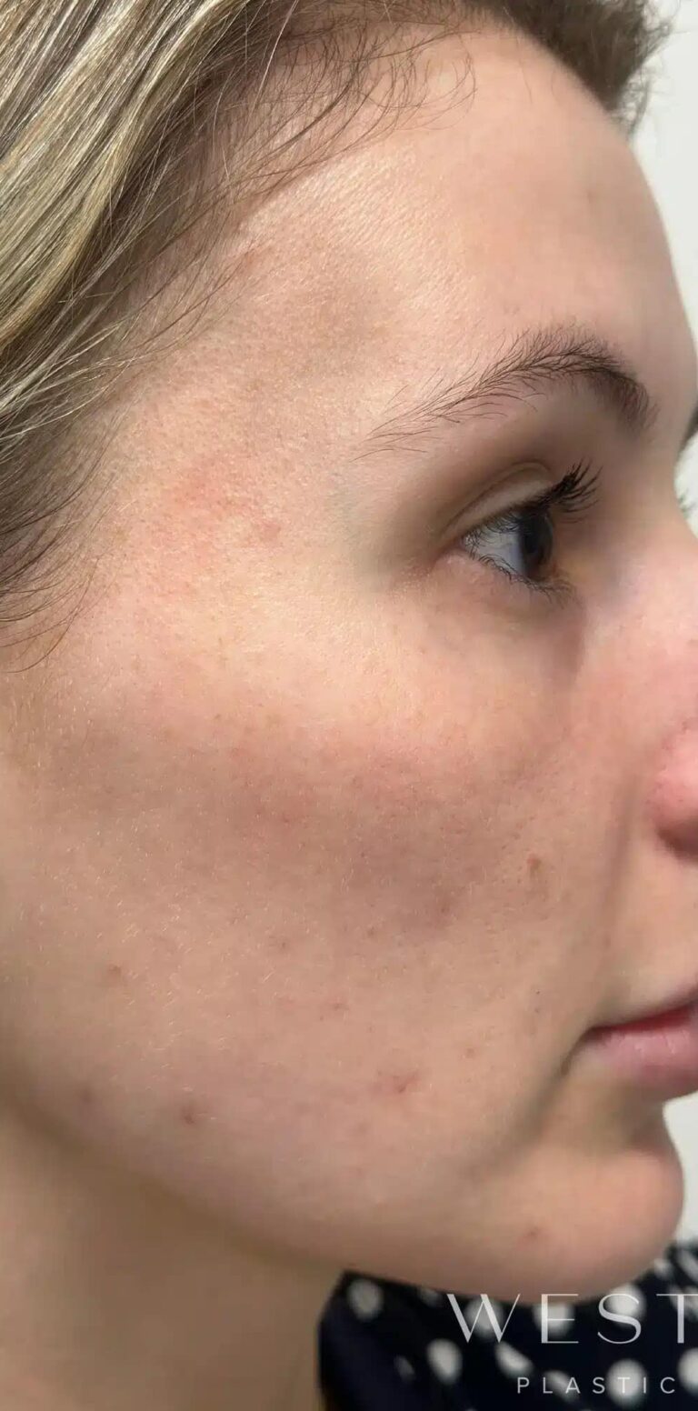 Before Image: Laser Genesis - right-side