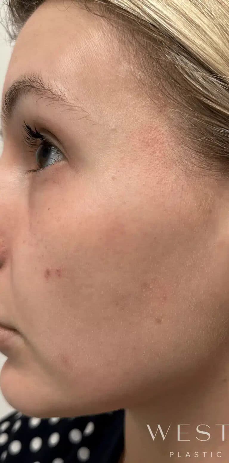 Before Image: Laser Genesis - left-side