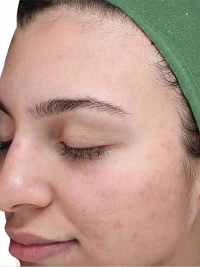 After Image: Chemical Peel (VI Peel) - left-front-oblique