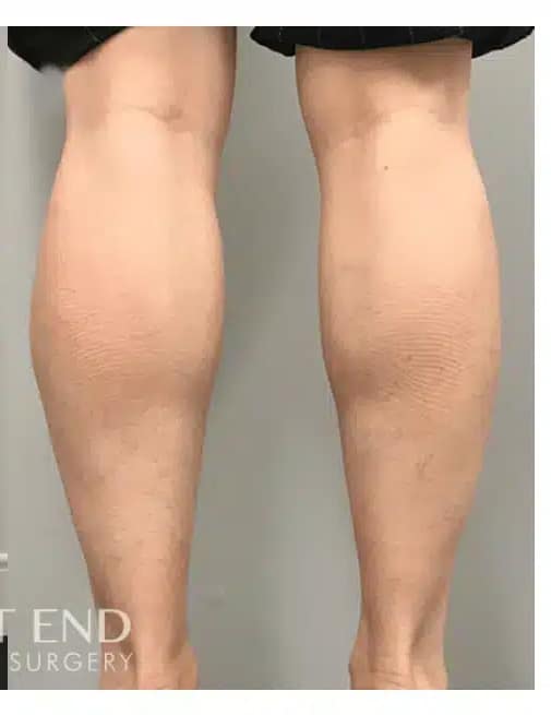 After Image: Calf Reduction with Botox - back