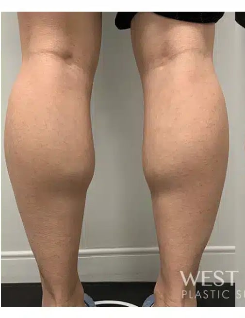 Before Image: Calf Reduction with Botox - back