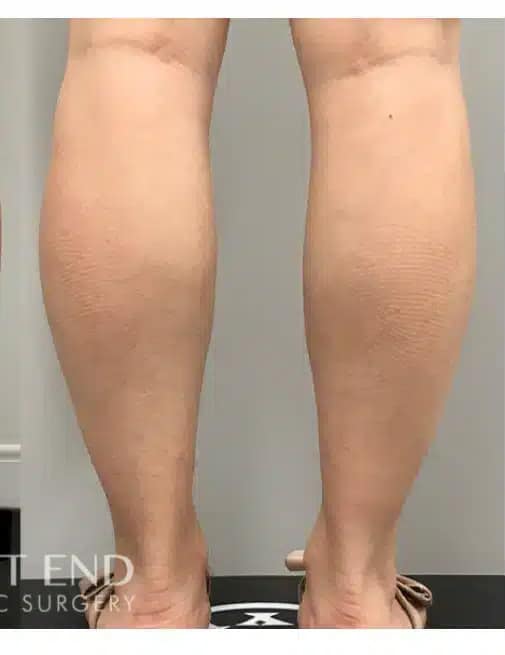 After Image: Calf Reduction with Botox - back