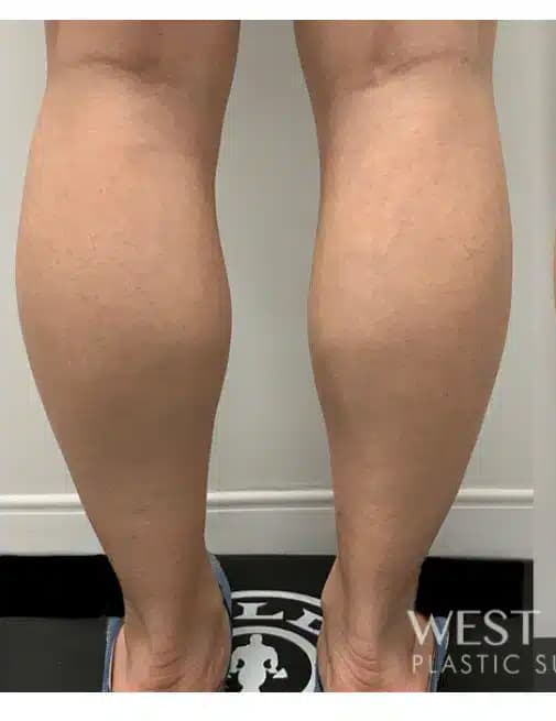 Before Image: Calf Reduction with Botox - back