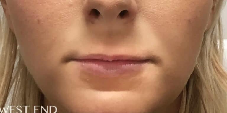 Before Image: Lip Filler - front