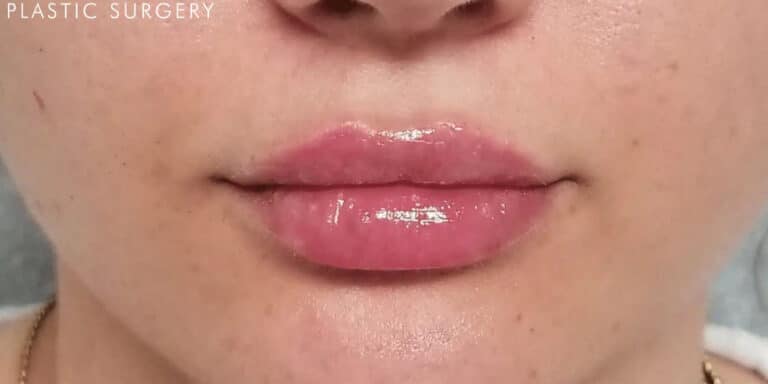 After Image: Lip Filler - front