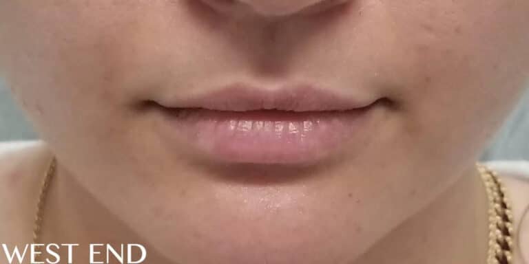 Before Image: Lip Filler - front