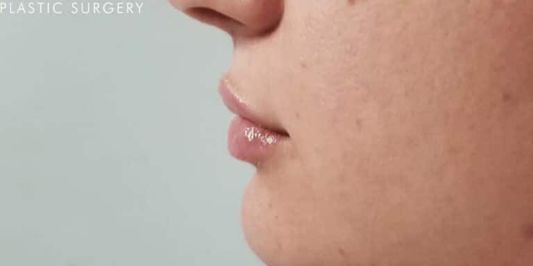 After Image: Lip Filler - left-side