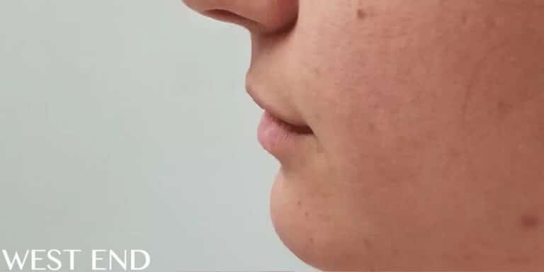Before Image: Lip Filler - left-side