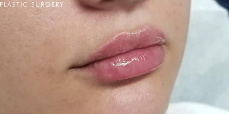 After Image: Lip Filler - right-front-oblique