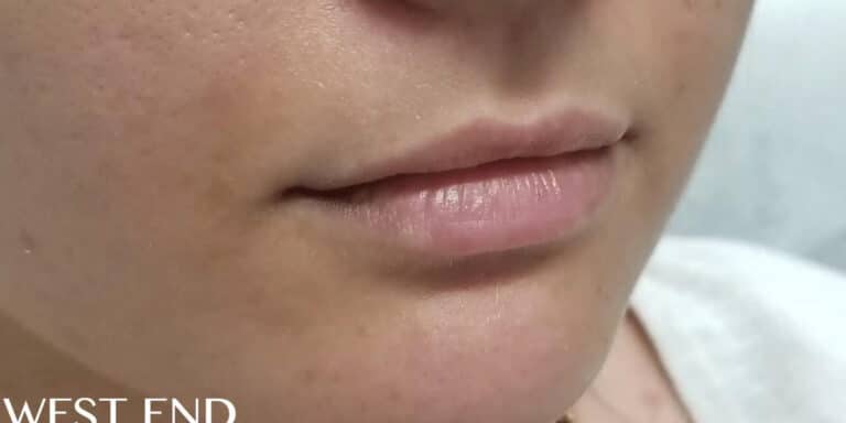 Before Image: Lip Filler - right-front-oblique