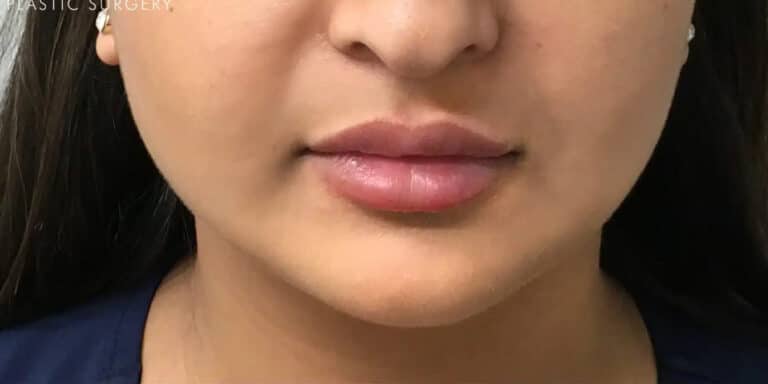 After Image: Chin Augmentation with Dermal Filler & Lip Filler - front