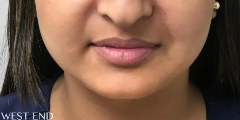 Before Image: Chin Augmentation with Dermal Filler & Lip Filler - front