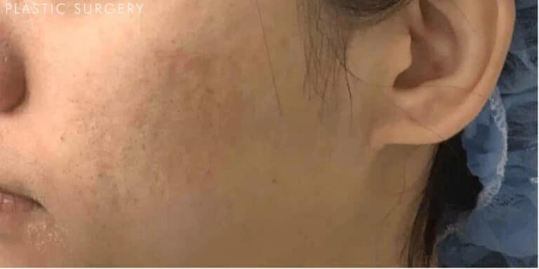After Image: Microneedling with PRP - left-side
