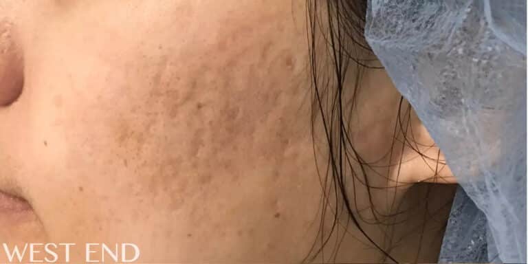 Before Image: Microneedling with PRP - left-side