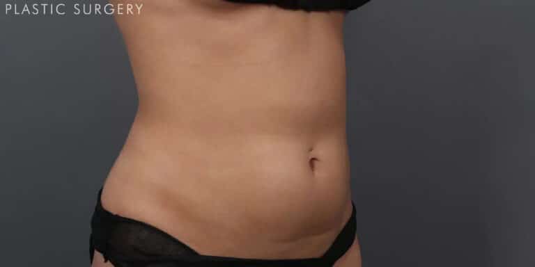 After Image: CoolSculpting - right-front-oblique