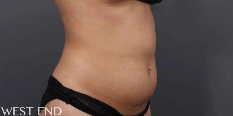 Before Image: CoolSculpting - right-front-oblique
