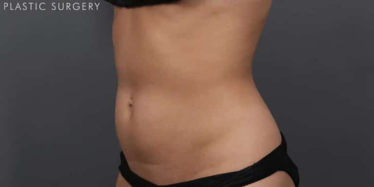 After Image: CoolSculpting - left-front-oblique