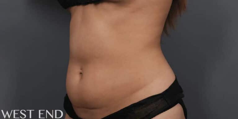 Before Image: CoolSculpting - left-front-oblique