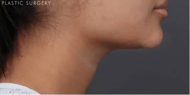 After Image: CoolSculpting - right-side