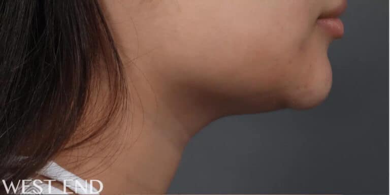 Before Image: CoolSculpting - right-side