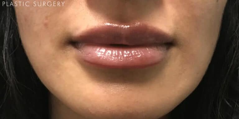After Image: Lip Filler - front