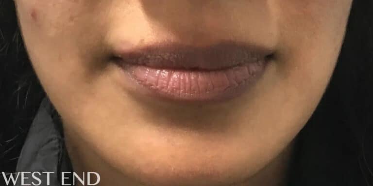 Before Image: Lip Filler - front