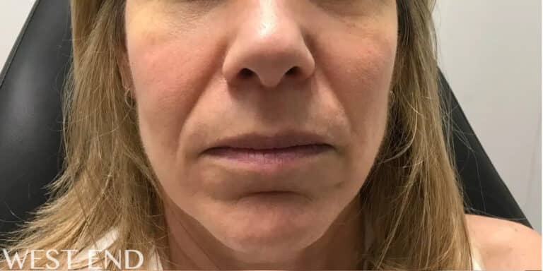 Before Image: Cheek Filler - front