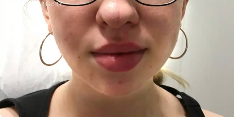 After Image: Kybella & Chin Augmentation with Dermal Filler - front