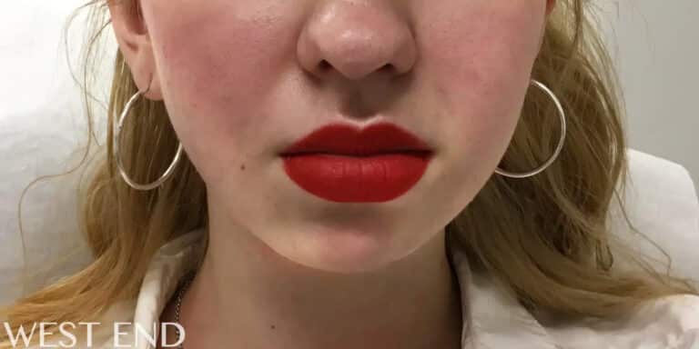 Before Image: Kybella & Chin Augmentation with Dermal Filler - front