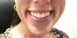 After Image: Neurotoxin for a “Gummy Smile”
