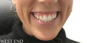 Before Image: Neurotoxin for a “Gummy Smile”