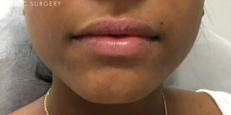 After Image: Lip Filler - front