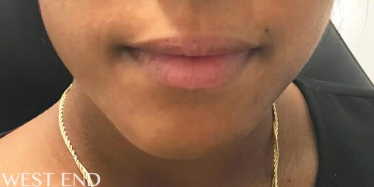 Before Image: Lip Filler - front