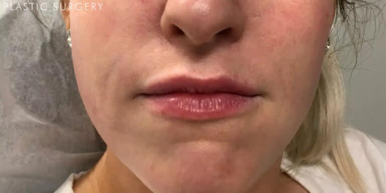 After Image: Lip Filler - front
