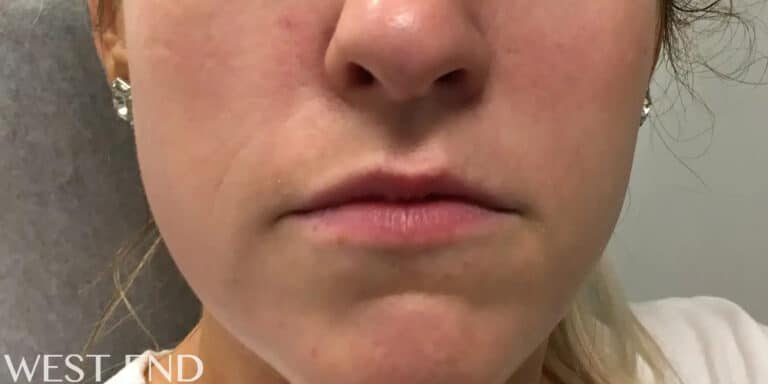 Before Image: Lip Filler - front