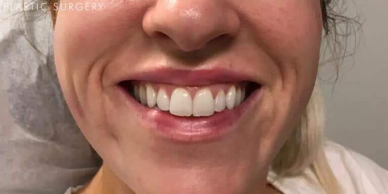 After Image: Lip Filler - front
